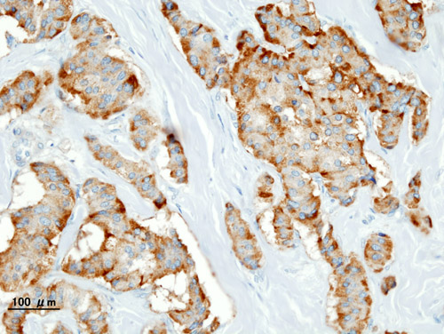 Histopathology of a pancreatic endocrine tumor (insulinoma). Chromogranin A immunostain. Source:https://librepathology.org/wiki/Neuroendocrine_tumour_of_the_pancreas[1]