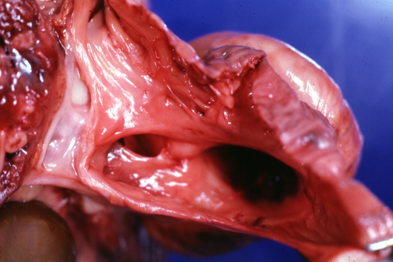 Atrial Septal Defect: Gross natural color infant heart foramen ovale defect, septum secundum