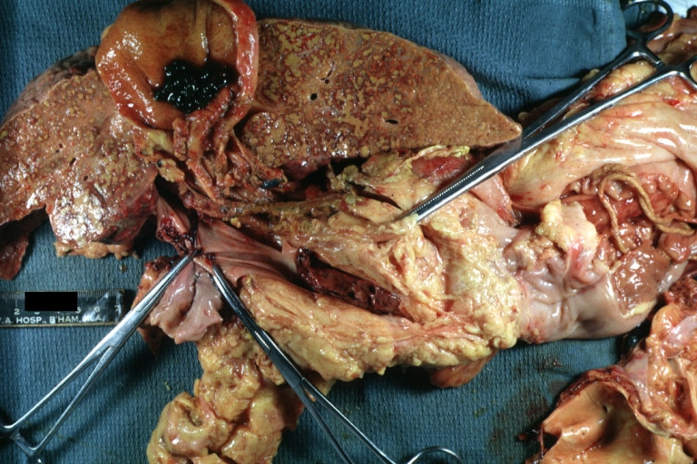 Cirrhosis with portocaval shunt: Gross, severe cirrhosis with extensive liver necrosis due to thrombosis of portocaval shunt (well shown)