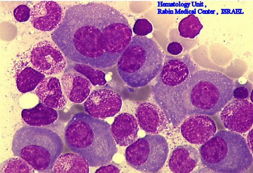Multiple Myeloma slide showing plasma cells with large nucleus and scant cytoplasm [11]