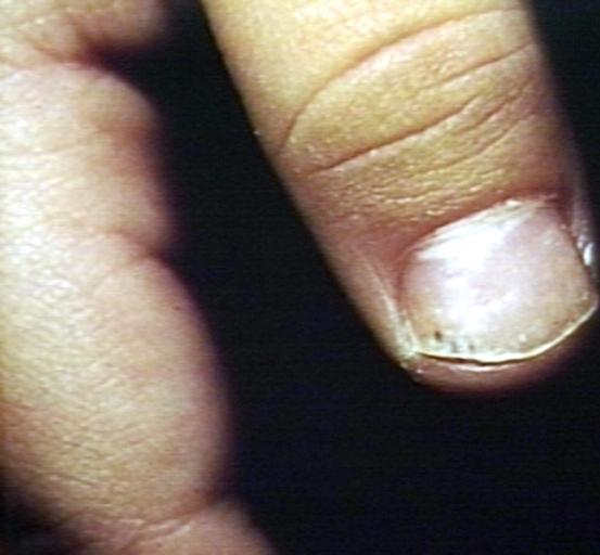 Nail disease, secondary to psoriasis