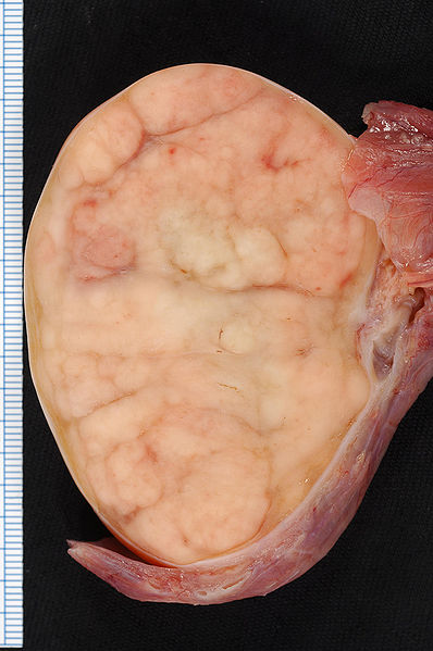 Gross specimen of testicle demonstrating a solid, white/tan mass.