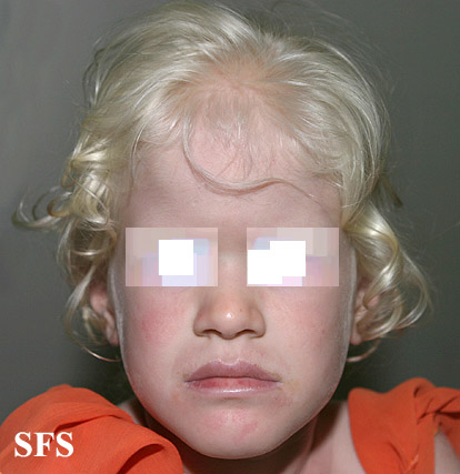 File:Albinism 01.jpeg