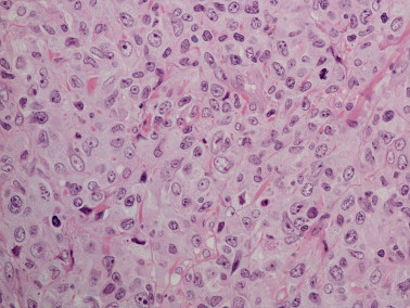 Pathology:Monomorphic high grade B cell PTLD