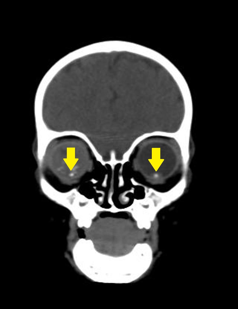 File:Retinoblastoma-7 (2).jpg