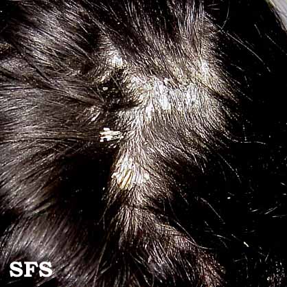 Tinea amiantacea. Adapted from Dermatology Atlas.[7]