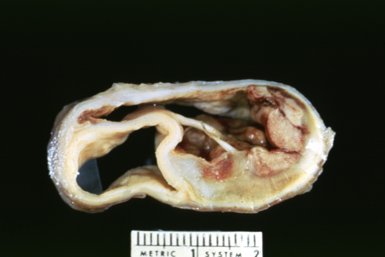 Dissecting Aneurysm: Gross cross section of aorta with two channels (a good example)