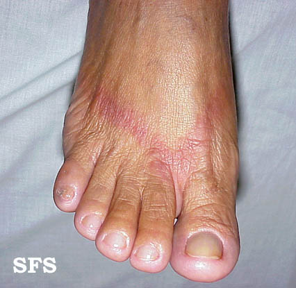 File:Contact dermatitis15.jpg