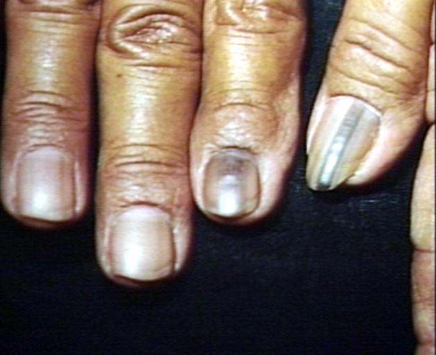 Nail disease, brown banding