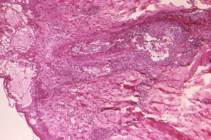 Hematoxylin-eosin (H&E)-stained photomicrograph reveals some of the cytoarchitectural histopathologic changes which you’d find in a human skin tissue specimen that included a chickenpox, or varicella zoster virus lesion (50x mag). From Public Health Image Library (PHIL). [2]