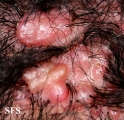 Folliculitis Cheloidalis. Used with permission of Dermatology Atlas