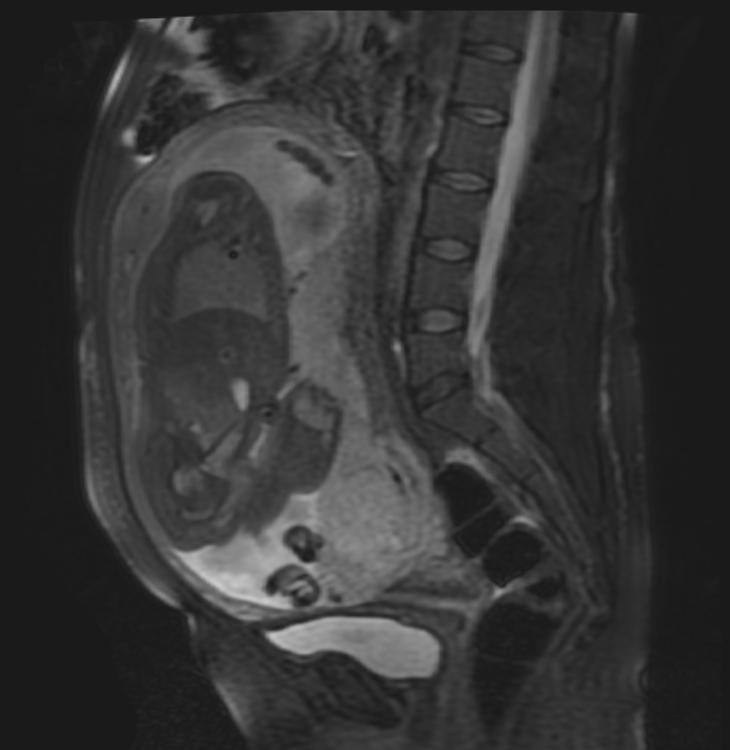File:Placenta previa MRI 002.jpg