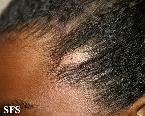 File:Alopecia acquisitum centrifugum01.jpg
