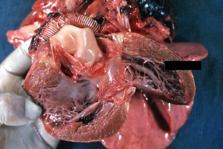 Ventricular Septal Defect: Gross, subvalvular defect, left ventricle view of tetralogy of Fallot (very good example)