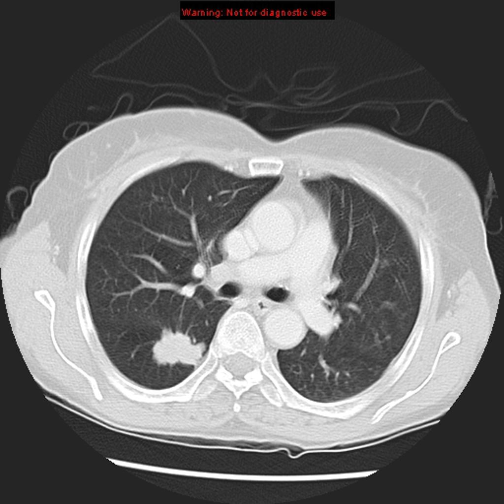 Adenocarcinoma of the lung: ground-glass attenuation corresponds to a lepidic growth pattern and the solid component correspond to invasive patterns. Case courtesy of Dr Ahmed Abd Rabou. Source: Radiopaedia.org [3]