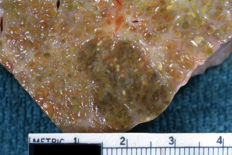 Endstage cirrhosis: Gross, natural color, close-up cut surface, very well shown nodules of yellow and necrotic opaque liver tissue with broad and irregular bands of fibrosis (an excellent example)