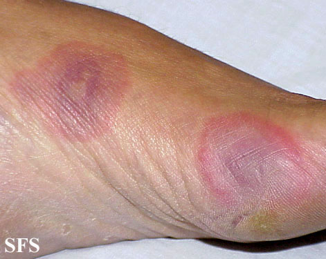 Erythema multiforme Adapted from Dermatology Atlas.