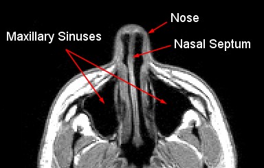 MRI image showing nasal septum.