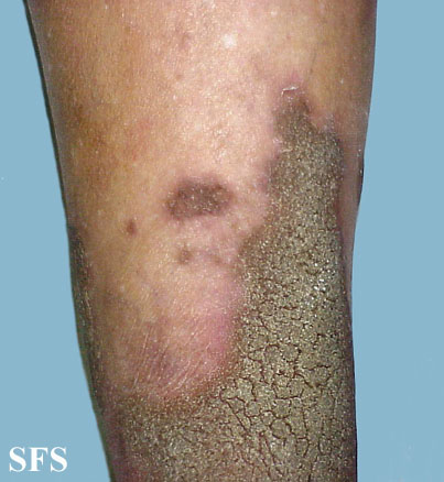 Progressive palmoplantar keratoderma. With permission from Dermatology Atlas.[1]