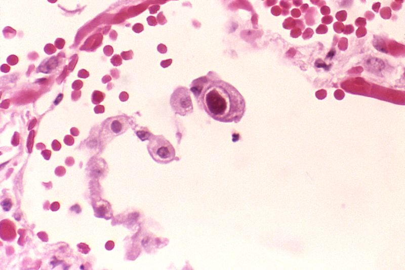 CMV infection of a lung pneumocyte.