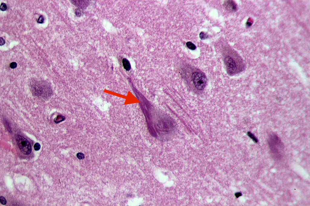 Neurofibrillary tangle (red arrow)
