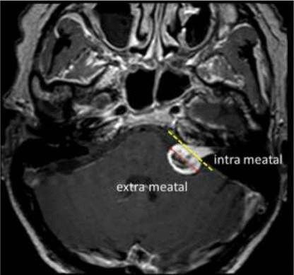 MR image of left sided vestibular schwannoma. Yellow dotted line is border between intra- and extrameatal portion of the tumour. Size quantified as the largest diameter measurable in the extrameatal portion (red line), Kleijwegt MC, van der Mey AG, Wiggers-deBruine FT, Malessy MJ, van Osch MJ. Perfusion magnetic resonance imaging provides additional information as compared to anatomical imaging for decision-making in vestibular schwannoma. Eur J Radiol Open. 2016;3:127–133. Published 2016 Jun 15. doi:10.1016/j.ejro.2016.05.005,https://www.ncbi.nlm.nih.gov/pmc/articles/PMC4919314/
