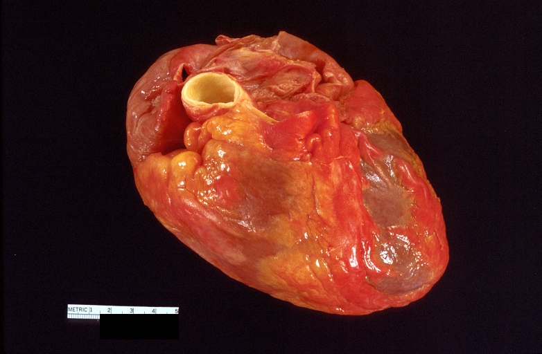 Scleroderma: Right ventricular hypertrophy due to pulmonary fibrosis in Scleroderma