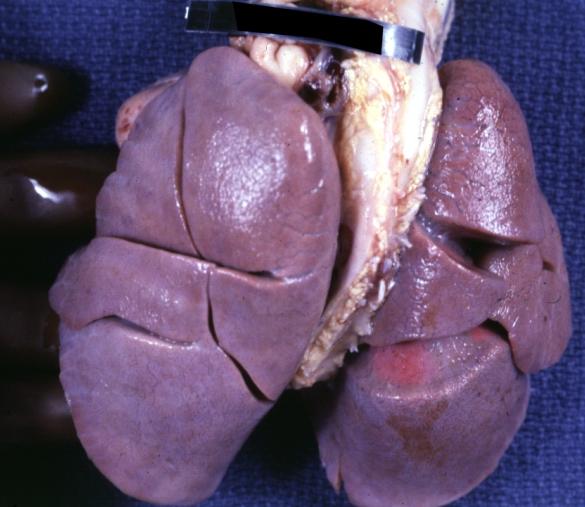 Lung: Abnormal Lobation: Gross fixed tissue posterior view both lungs with many lobes case of cor triatriatum