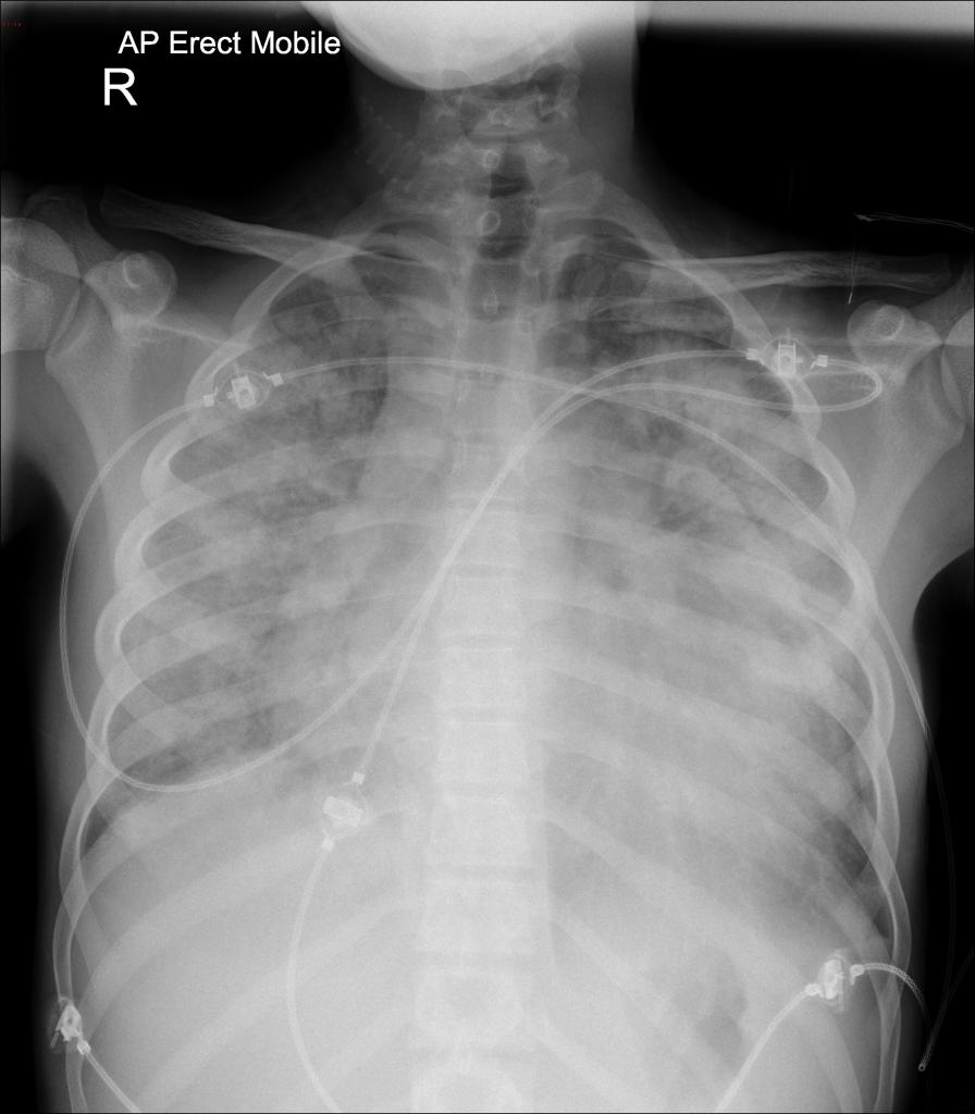 Plain chest film demonstrates bilateral increased interstitial markings.<ref name=XRAY> Image courtesy of Dr. David Preston Radiopaedia (original file [1]). Creative Commons BY-SA-NC