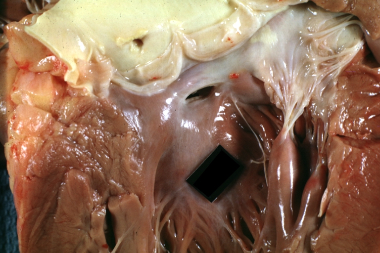 Ventricular Septal Defect: Gross close-up adult heart, small perimembranous septal defect (very good example)