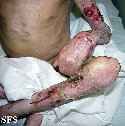 Epidermolysis bullosa dystrofic recessive. Adapted from Dermatology Atlas.[8]
