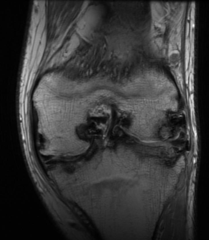 Knee MRI in a patient with Hemophilia