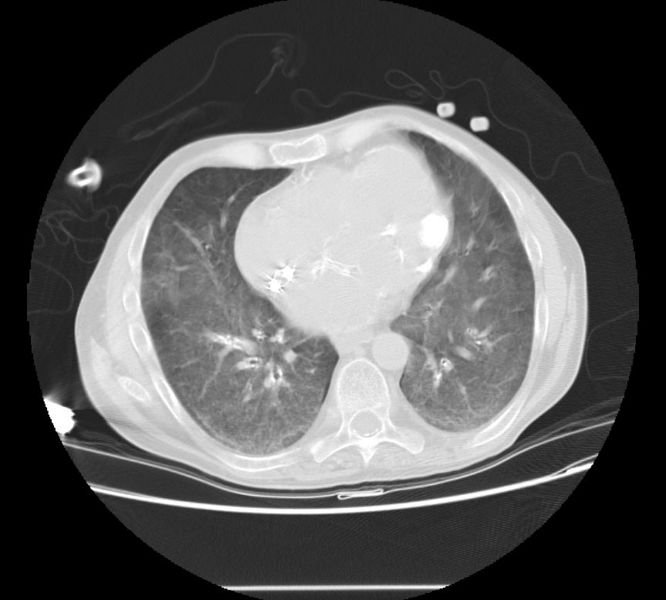 File:Metastatic pulmonary calcification 104.jpg