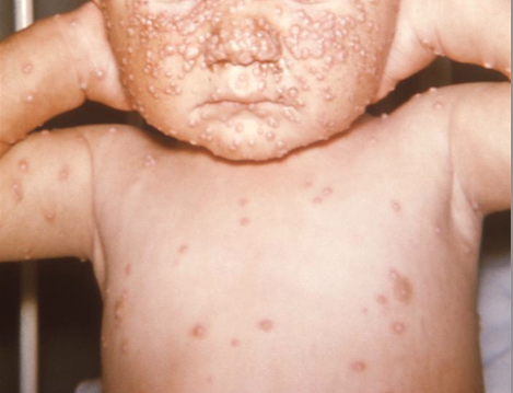 Face and upper body of child whose skin displayed the characteristic maculopapular lesions of the milder form of smallpox, or the DNA virus, variola minor. From Public Health Image Library (PHIL). [5]