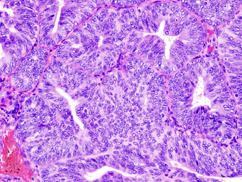Histopathologic representation of endometrioid adenocarcinoma demonstrated in endometrial biopsy. Hematoxylin-eosin stain.