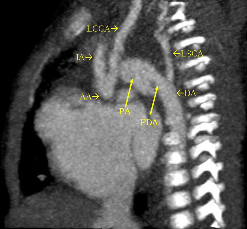 20-days old male presented with heart failure. The arch is interrupted between left CCA and SCA. The pulmonary artery is markedly dilated and connected to descending aorta via large PDA giving the appearance of a low aortic arch. The PA is much larger than ascending aorta. Other associated anomalies in this case included VSD and large sinus venosus ASD.(Image courtesy of Dr Ahmed Haroun)