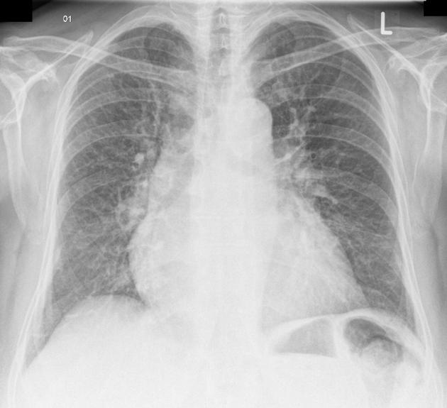 Pulmonary congestion in heart failure with Kerley B lines. (Image courtesy of Radiopaedia.org)