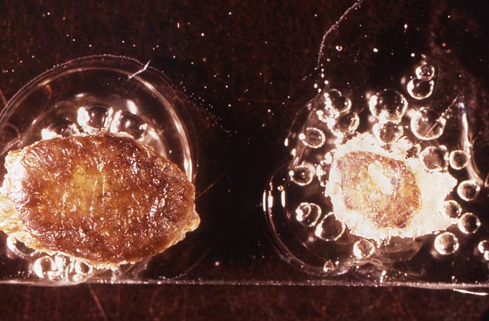 Viewed from above, this image depicts a smallpox scab (left), and chickenpox scab (right) as a demonstration in comparative morphology. From Public Health Image Library (PHIL). [27]