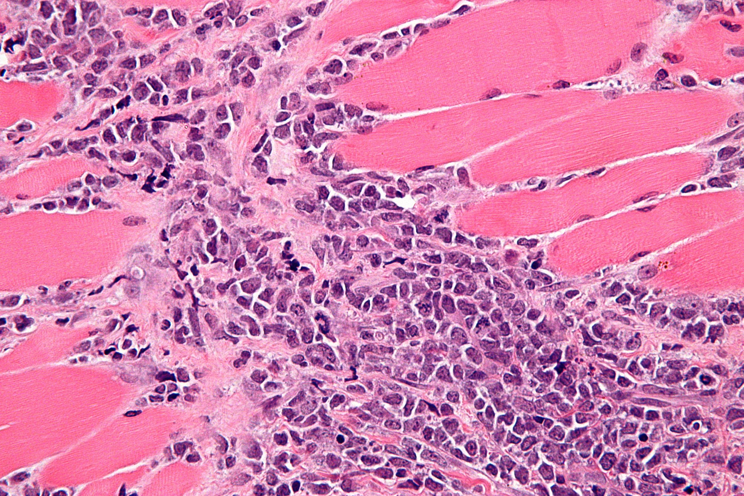 File:Chloroma histopathology micrograph (H&E stain).jpeg