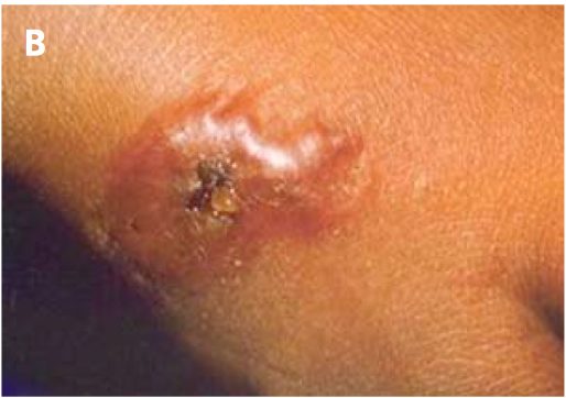 Day 2 - 3 of development and resolution of uncomplicated cutaneous anthrax lesion.”Adapted from World Health Organization (WHO)[2]