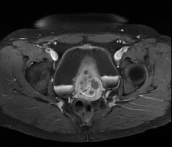 File:Large nabothian cysts MRI 005.jpg