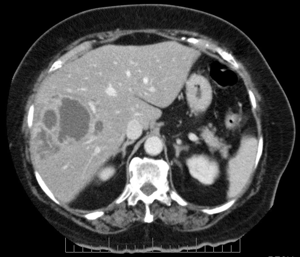 Hepatic abscess: peripheral enhancement, centrally hypoattenuating lesions. Occasionally they appear solid, or contain gas. Segmental perfusion abnormalities, with early enhancement, may be seen.
