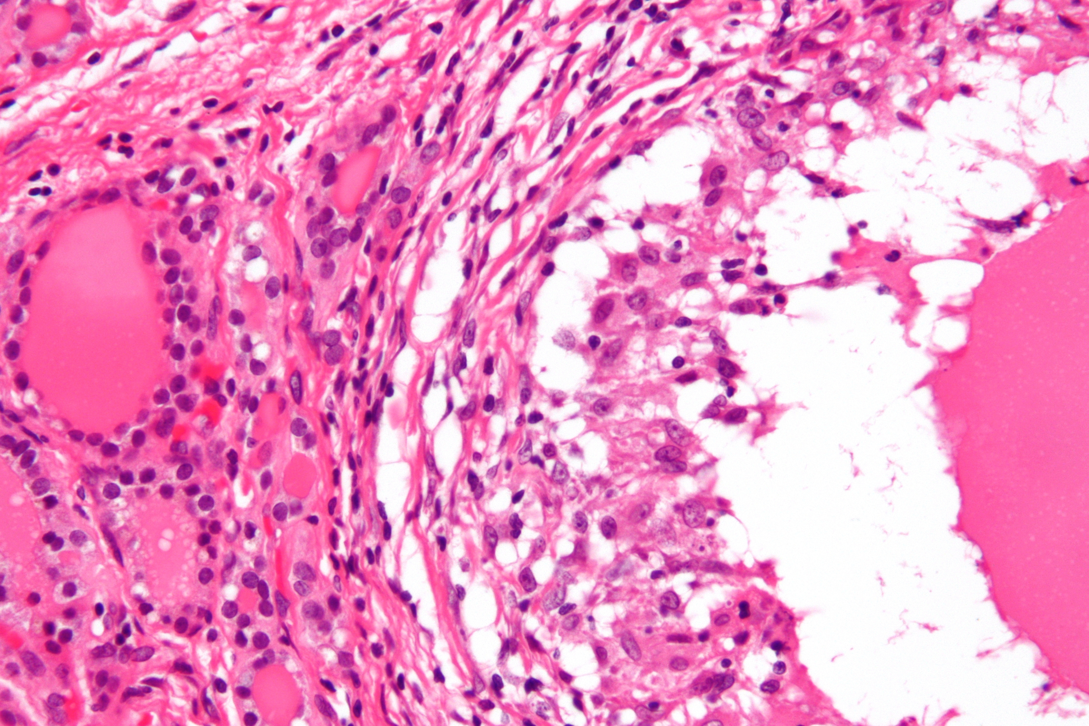 Histology of De Quervain's thyroiditis; Granuloma (By Nephron - Own work, CC BY-SA 3.0, https://commons.wikimedia.org/w/index.php?curid=18491421)
