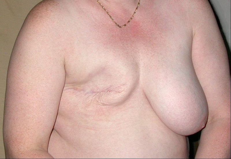 File:Breast cancer 2.jpg