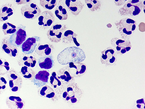 A cytospin of a CSF showing a Naegleria fowleri trophozoite amidst polymorphonuclear leukocytes and a few lymphocytes.