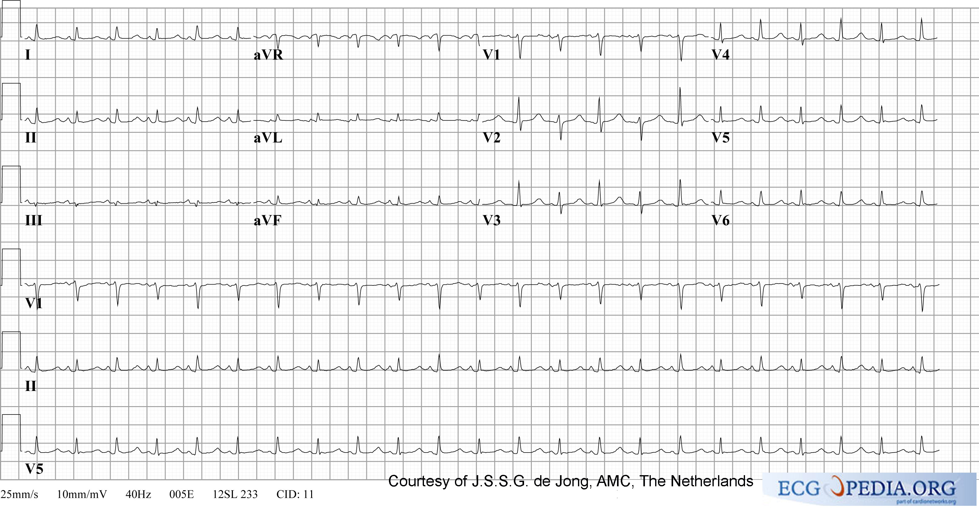 The above EKG shows low voltage QRS complexes and electrical alternans