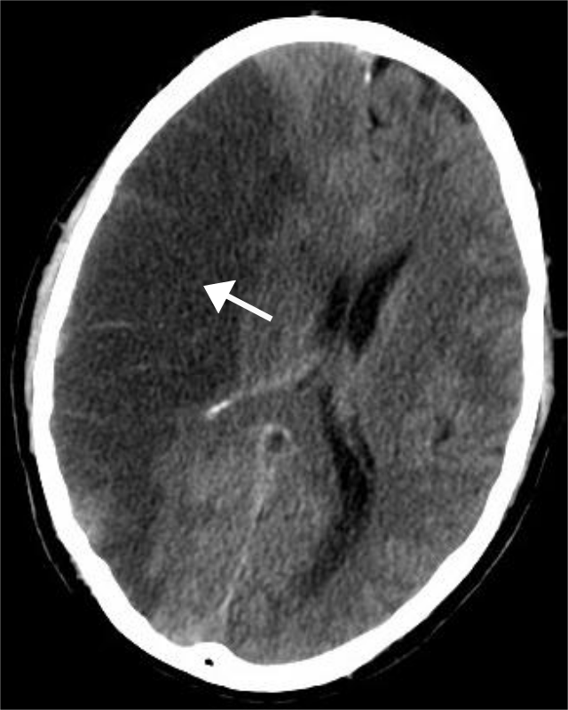File:Stroke CT03.png