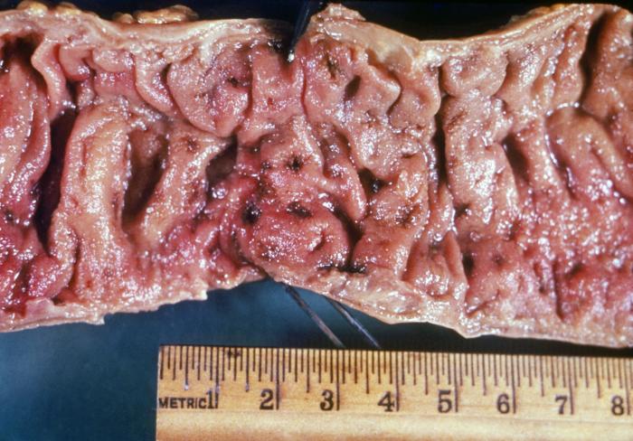 Intestinal ulcers due to amebiasis. Adapted from Public Health Image Library (PHIL). [1]