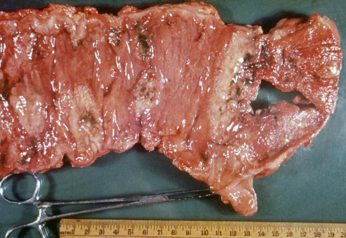 Intestinal ulcers due to amebiasis. Adapted from Public Health Image Library (PHIL). [1]