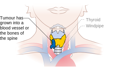 Stage T4b thyroid cancer